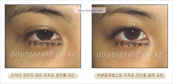 [두한성형외과 경쟁력 눈성형] - [쌍꺼풀 재수술에 대한 최선의 대안 제시] 관련 이미지 29