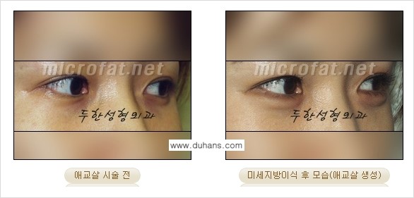 [두한성형외과 무한 경쟁력 눈밑성형] - [애교살 시술 2.] 관련 이미지 1