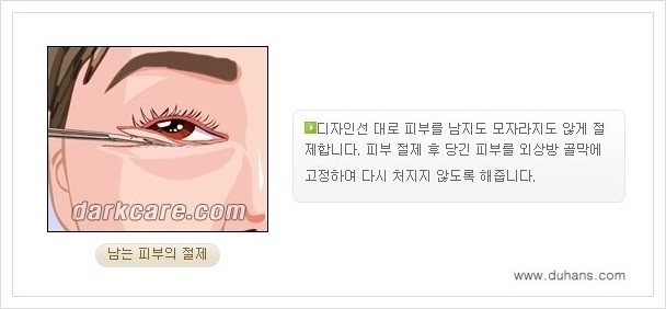 [두한성형외과 경쟁력 다크써클 치료] - [하안검 성형과 눈밑지방 재배치 안내] 관련 이미지 7