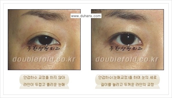 [두한성형외과 경쟁력 쌍꺼풀(눈) 재수술] - [쌍꺼풀(눈) 재수술, 극한 재수술 클리닉의 특성] 관련 이미지 5