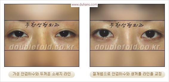 [두한성형외과 경쟁력 눈성형] - [극한 재수술, 함몰된 눈꺼풀 라인교정, 안검하수(졸리운 눈매)] 관련 이미지 104