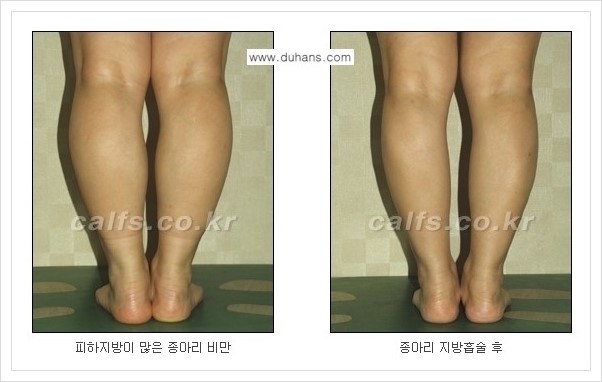 [두한성형외과 경쟁력 멀티종아리성형] - [예쁜 종아리를 만드는 종아리 지방흡입술 안내] 관련 이미지 9