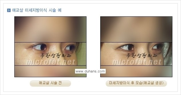 [두한성형외과 경쟁력 눈밑성형] - [눈밑 다크써클과 눈밑 애교살과의 관계] 관련 이미지 6