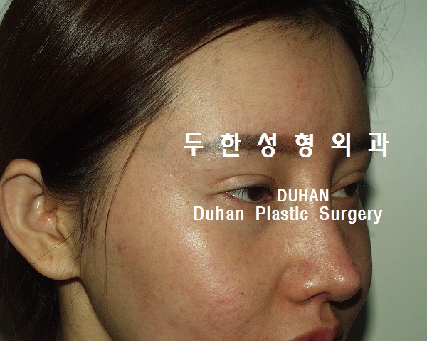 큰 아웃라인,#안검하수 #눈재수술, #애교살 #지방이식 관련 이미지 2