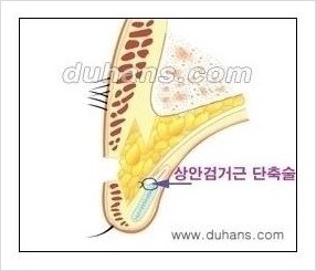 [두한성형외과 경쟁력 쌍꺼풀 재수술, 극한 눈재수술] - [쌍꺼풀 재수술, 눈재수술 실패의 원인 안내] 관련 이미지 6