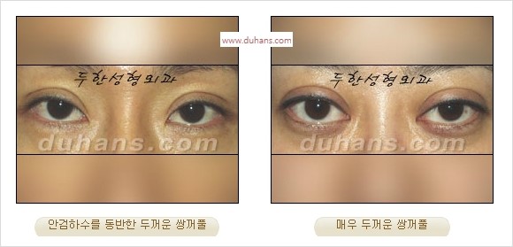 [두한성형외과 경쟁력 눈성형] - [나에게 맞는 어울리는 쌍꺼풀 라인] 관련 이미지 5