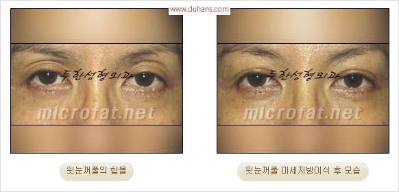 [두한성형외과 경쟁력 눈성형 리더] - [윗눈꺼풀 함몰( #꺼진눈꺼풀) 미세지방이식과 상안검성형]#꺼진눈성형 , #눈위함몰 관련 이미지 19