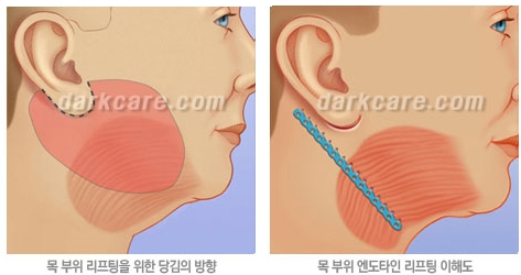 Duhan Plastic Surgery Combo Program - Dark Circles and Lifting image 9