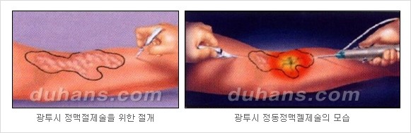 [두한성형외과 정맥류] - [하지정맥류, 정맥확장증, 혈관확장증] 관련 이미지 17