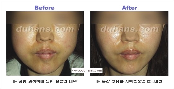 [두한성형외과 경쟁력 얼굴지방흡입] - [통통한 볼살, 두툼한 턱살(턱선)의 지방흡입] 관련 이미지 11