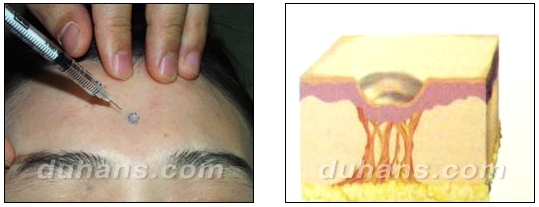 [DuHan Plastic Surgery Scar] - [DHL Simple Scar Treatment] image 1