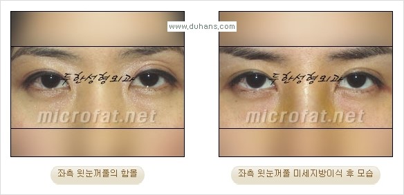 [두한성형외과 경쟁력 미세 #지방이식 ] - [윗 #눈꺼풀함몰, #꺼진눈꺼풀, #눈위지방이식, #눈위함몰] 관련 이미지 17