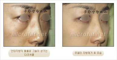 두한성형외과 눈밑수술 - 다크서클 수술 전후 관리 안내 관련 이미지 67