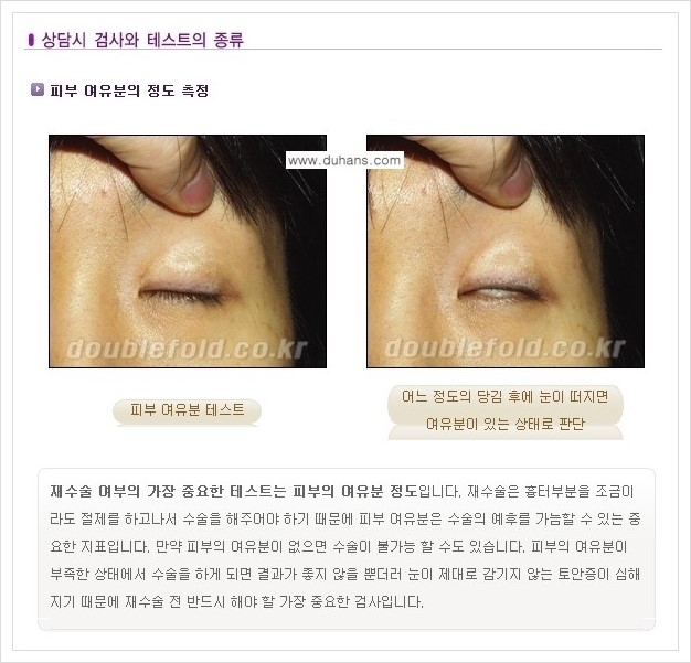 [두한성형외과 경쟁력 쌍꺼풀 재수술, 극한 눈재수술] - [쌍꺼풀 재수술을 위한 검사와 테스트] 관련 이미지 1