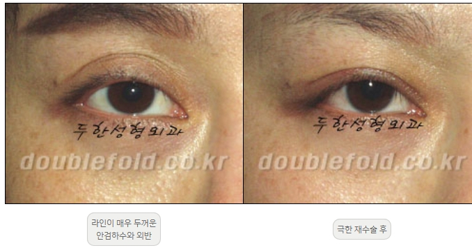 [Double Eyelid Surgery, Duhan Plastic Surgery] - [Extreme Revision Eye Surgery to Correct a Damaged Line] image 29