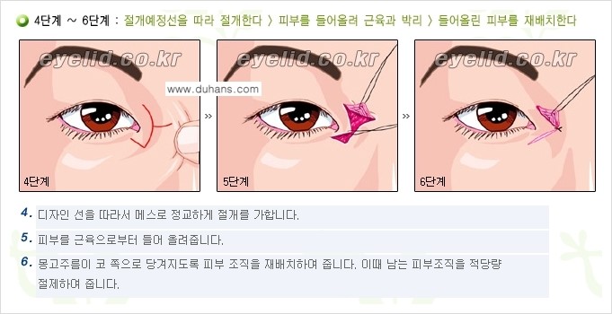 [두한성형외과 눈성형 FOCUS] - [몽고주름 제거(앞트임 제거) 수술 ③] 관련 이미지 9