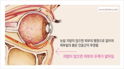 [두한성형외과 경쟁력 눈밑성형] - [눈밑 안와지방 돌출의 무통마취 무흉터 눈밑지방제거 안내] 관련 이미지 3