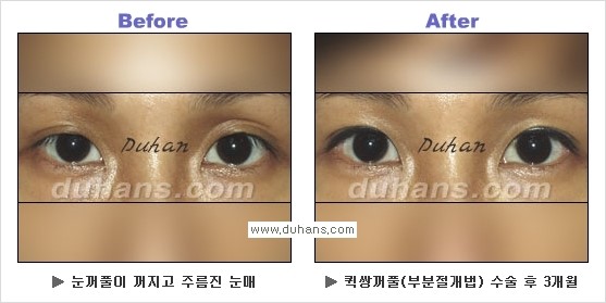 ​[두한성형외과 경쟁력 눈성형] - [자연스럽고 아름다운 쌍꺼풀의 기준] 관련 이미지 24