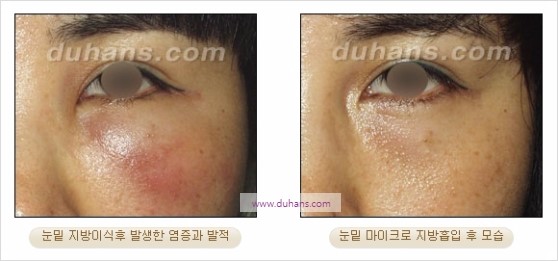 [두한성형외과 경쟁력 지방흡입] - [볼살, 턱선의 간편 지방흡입] 관련 이미지 34