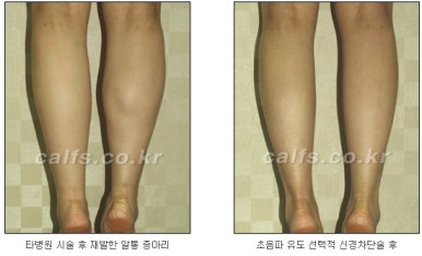 ​[두한성형외과 종아리수술] - [나에게 맞는 종아리성형방법] 관련 이미지 5