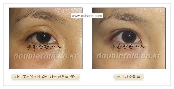 [두한성형외과 경쟁력 쌍꺼풀 재수술] - [극한의 상태에서 쌍꺼풀 재수술 안내 ①] 관련 이미지 7