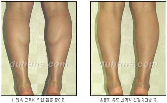 [Duhan Plastic Surgery Calf Reduction] - [How to Get Rid of Calf Muscle Bulges] image 26