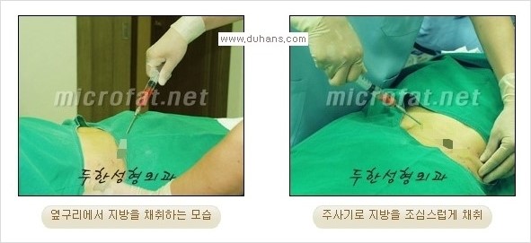 ​​​[두한성형외과 경쟁력 지방이식] - [지방이식을 이용한 입술성형 안내] 관련 이미지 4