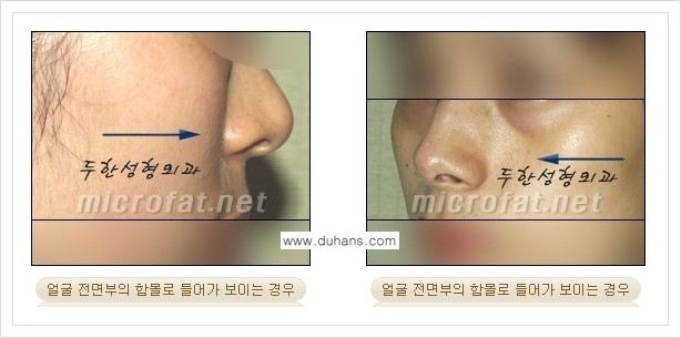 [두한성형외과 경쟁력 미세지방이식] - [귀족수술과 인디언밴드(앞광대주름) 미세지방이식] 관련 이미지 1
