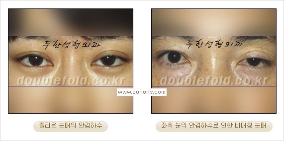 [두한성형외과 경쟁력 눈성형] - [안검하수 교정의 목적] 관련 이미지 6