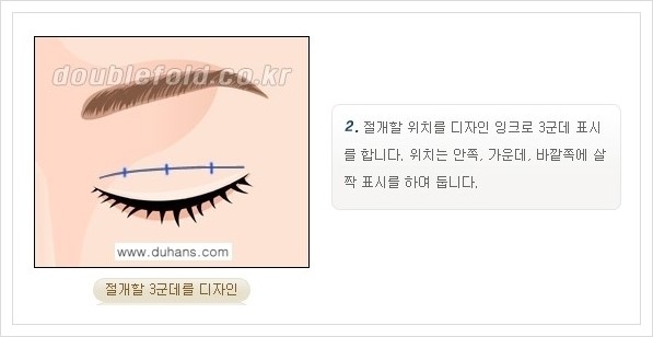 [두한성형외과 경쟁력 쌍꺼풀 재수술, 극한 재수술] - [쌍꺼풀 재수술의 과정 안내 1.] 관련 이미지 12