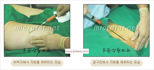 [두한성형외과 경쟁력 미세지방이식] - [타 병원의 지방이식 부작용 교정 - 정교한 마이크로 지방이식, 흡입 안내] 관련 이미지 25