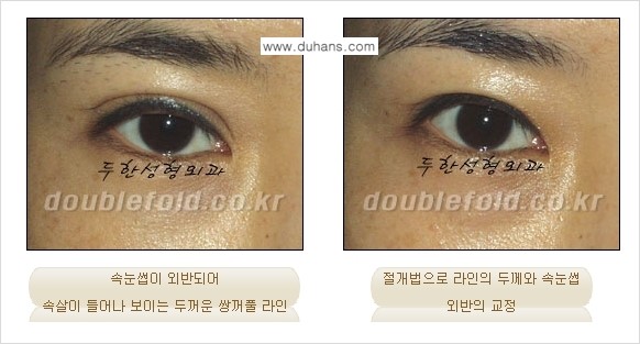 [두한성형외과 경쟁력 쌍꺼풀 재수술, 극한 눈재수술] - [쌍꺼풀 재수술 방법 - 속눈썹 외반] 관련 이미지 6