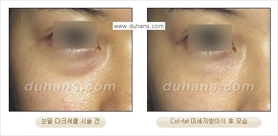 [두한성형외과 경쟁력 미세지방이식]-[Col-fat 입체지방이식 사례 안내] 관련 이미지 5
