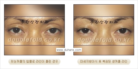 [두한성형외과 경쟁력 눈성형] - [미세지방이식으로 풀린 라인의 교정 방법 안내] 관련 이미지 5