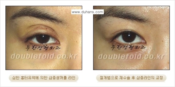 ⁠[두한성형외과 경쟁력 쌍꺼풀 재수술, 극한 눈재수술] - [삼중(세겹) 쌍꺼풀 라인의 교정] 관련 이미지 6