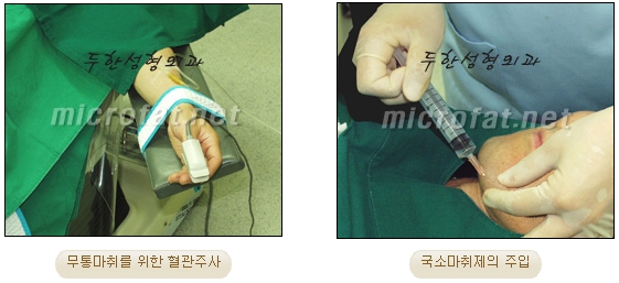 얼굴지방이식 두한성형외과 - 볼지방이식 관련 이미지 47