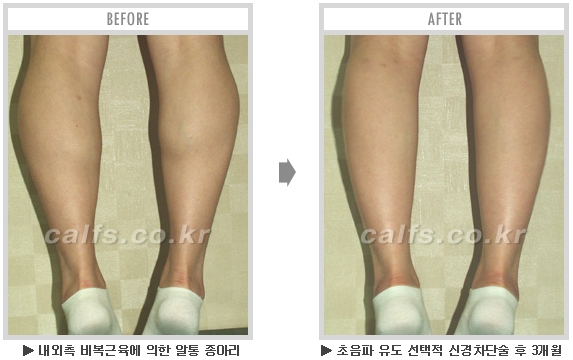 [종아리성형 두한성형외과] - [종아리수술에 대한 자주하는 질문과 답변 모음] 관련 이미지 61