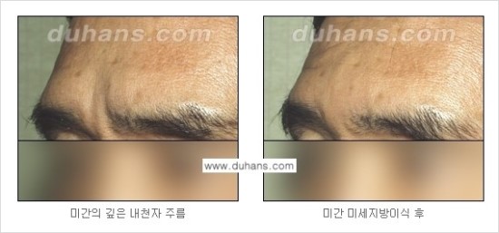 [두한성형외과 경쟁력 주름성형] - [세월의 흔적! 주름을 교정하는 여러 가지 교정 방법] 관련 이미지 18