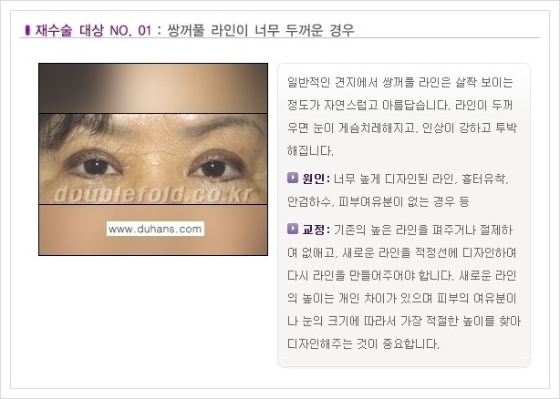 ⁠⁠[두한성형외과 경쟁력 쌍꺼풀 재수술, 극한 재수술] - [쌍꺼풀 재수술이 필요한 경우 안내] 관련 이미지 2