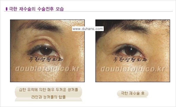 [두한성형외과 경쟁력 눈성형] - [극한의 상태에서 쌍꺼풀재수술(눈재수술) 안내] 관련 이미지 3