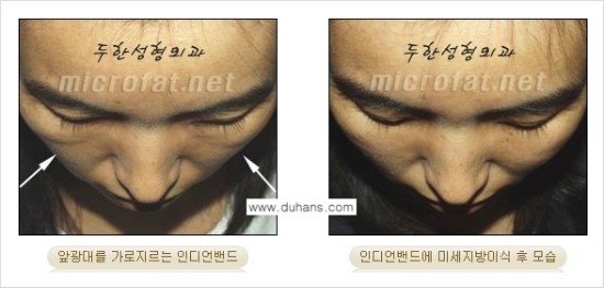 [두한성형외과 경쟁력 귀족성형] - [3차원 입체 미세지방이식 귀족수술 + 인디언밴드 교정] 관련 이미지 19