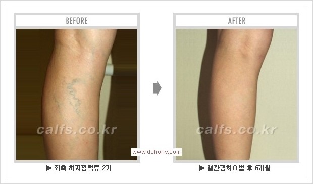 [두한성형외과 경쟁력 멀티종아리성형] - [종아리성형 방법별 전후 주의사항] 관련 이미지 34