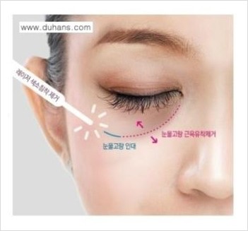 [두한성형외과 경쟁력 다크써클 교정] - [다크써클 5단계로 이뤄지는 핵심 5 STEP SOLUTION 안내 2.] 관련 이미지 1