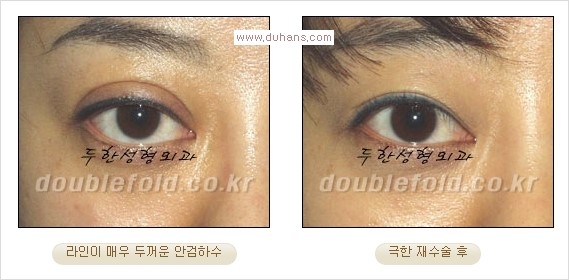 [두한성형외과 경쟁력 쌍꺼풀 재수술, 극한 재수술]- [쌍꺼풀 재수술의 성공 조건(Condition of successful reoperation) 관련 이미지 14