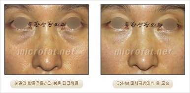 두한성형외과 눈밑수술 - 다크서클 수술 전후 관리 안내 관련 이미지 14
