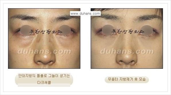 [두한성형외과 경쟁력 안검성형] - [눈밑 지방제거 안내] 관련 이미지 18
