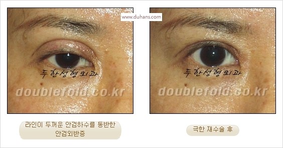 [두한성형외과 경쟁력 쌍꺼풀 재수술 스페셜] - [망가진 라인을 교정하는 극한 재수술] 관련 이미지 13