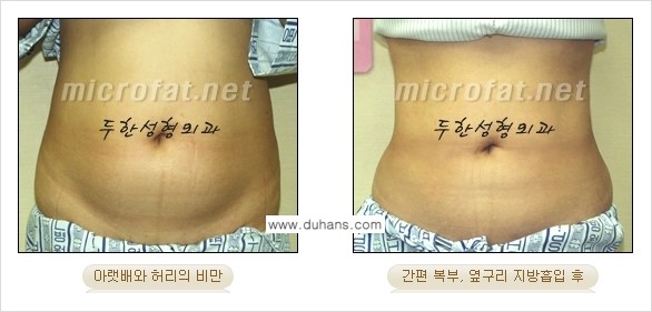 [두한성형외과 겨울엔 간편 지방흡입] - [복부, 뱃살, 아랫배, 옆구리 지방흡입 도전!] 관련 이미지 7