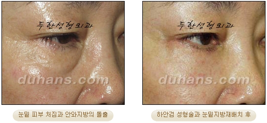 [Duhan Plastic Surgery Ophthalmic Plastic Surgery] - [Lower Blepharoplasty] image 29