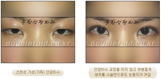 [Duhan Plastic Surgery Double Eyelid Revision Surgery] - [Ptosis, sausage eyelids] image 4